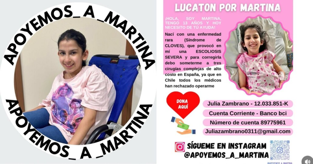¡Lucatón por Martina!: Niña de Angol requiere recolectar $200 millones para someterse a la única operación que puede salvar su vida.