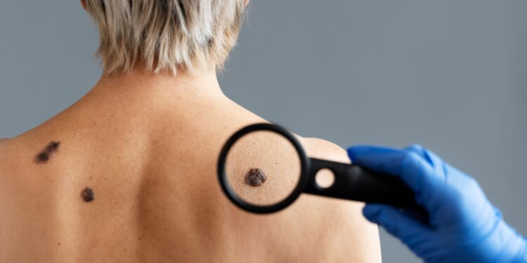 Día Mundial del Cáncer de Piel: se intensifica la prevención con recomendaciones de autocuidado.