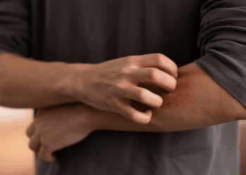 Escarlatina en la región del Maule: Medidas de prevención