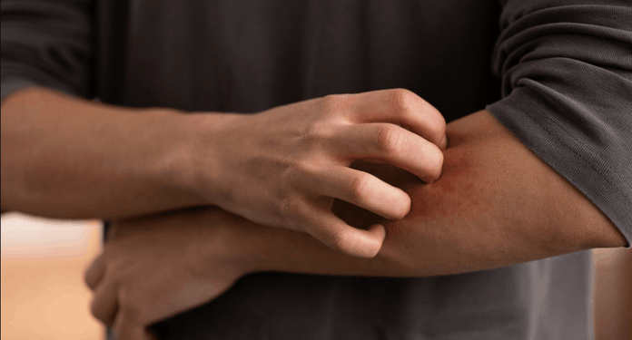 Escarlatina en la región del Maule: Medidas de prevención