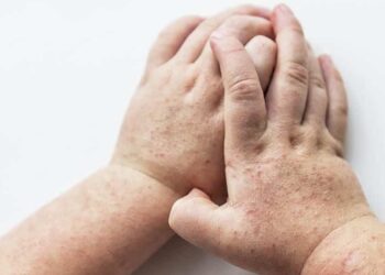 Escarlatina impacta a cinco individuos en Talca: Autoridades implementan plan de prevención.