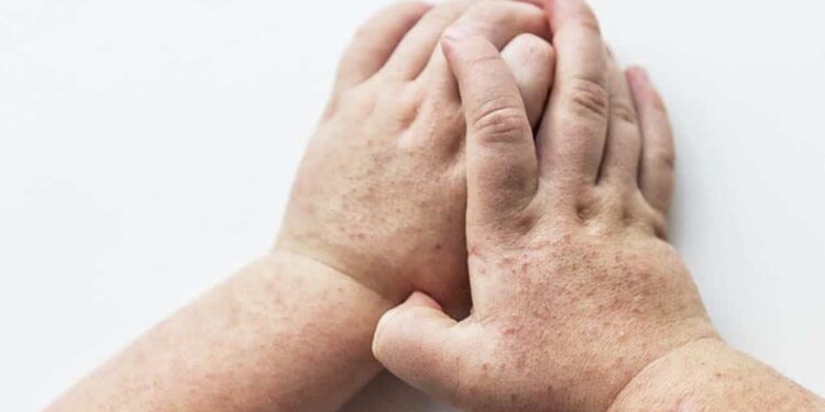 Escarlatina impacta a cinco individuos en Talca: Autoridades implementan plan de prevención.