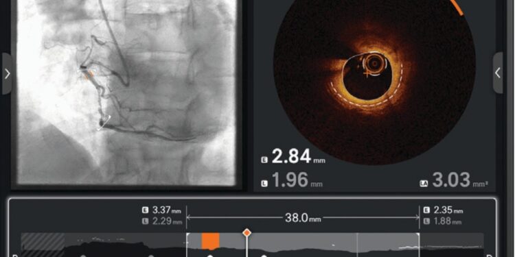 Ultreon 2.0 con IA llega a revolucionar la atención cardíaca en Chile.