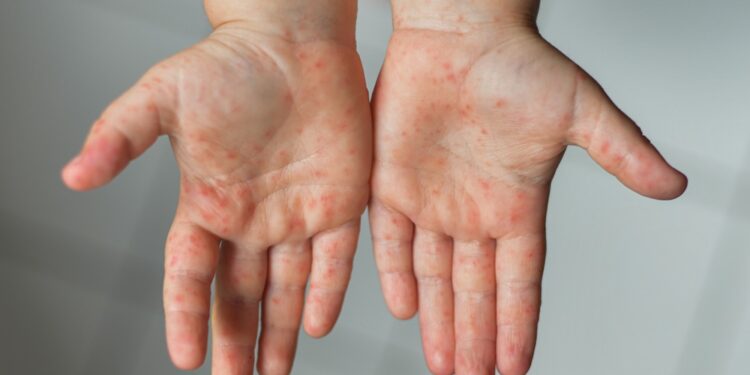 Aumento de la Enfermedad de Boca, Mano y Pie