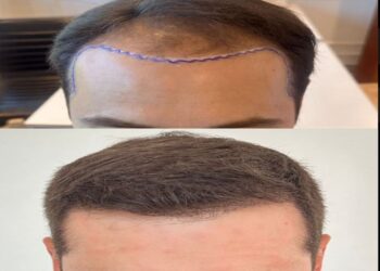 La solución definitiva para la alopecia en Chile