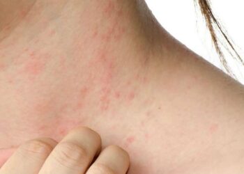 Síntomas, causas y cuidados imprescindibles