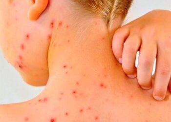 Minsal refuerza la alerta por sarampión y hace un llamado a vacunarse por el aumento de casos en la región.