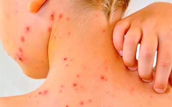 Minsal refuerza la alerta por sarampión y hace un llamado a vacunarse por el aumento de casos en la región.