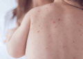 Chile emite alerta epidemiológica por sarampión debido al aumento de casos en Argentina.