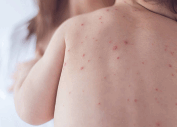 Chile emite alerta epidemiológica por sarampión debido al aumento de casos en Argentina.