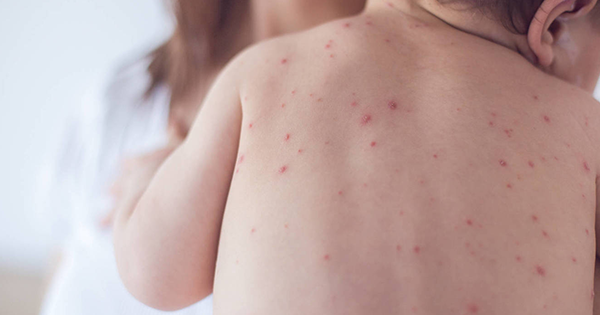 Chile emite alerta epidemiológica por sarampión debido al aumento de casos en Argentina.