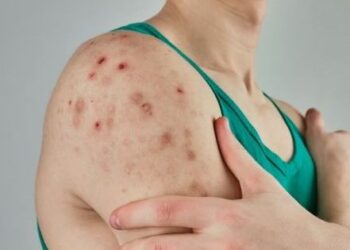 Minsal confirma el primer caso de sarampión importado en Chile desde 2023.